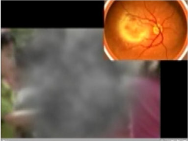 Image of eye with age related macular degeneration