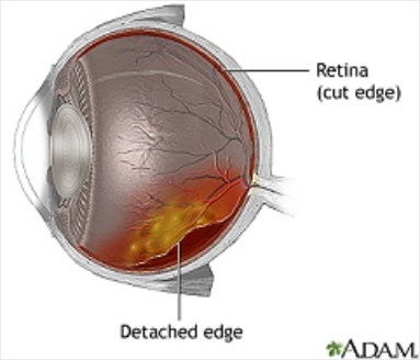 Image of eye with retinal detachment